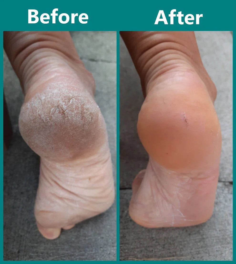 Fino Foot Care Device | Waterproof, Dual Roller Exfoliation 4