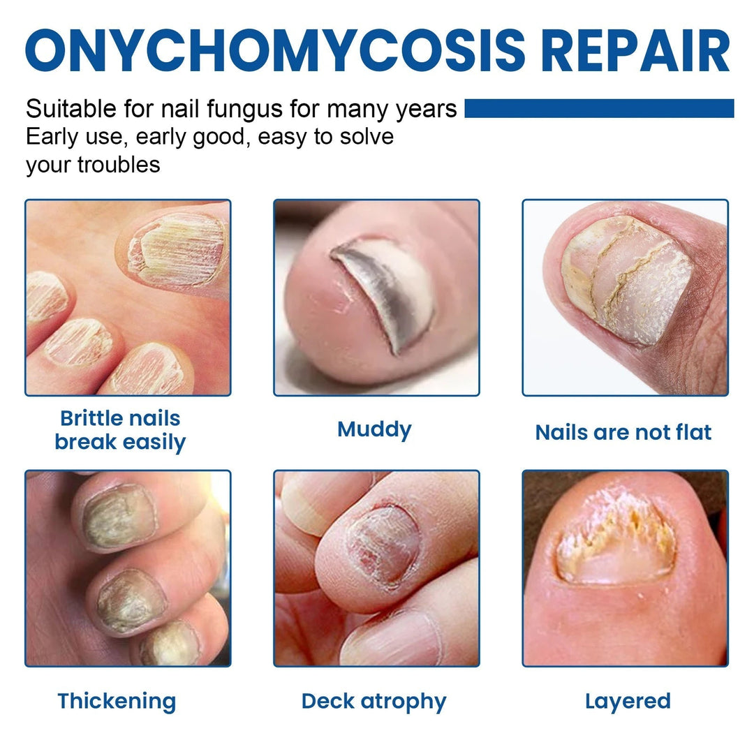 Fungal Revive Nail Treatment Patches | Targeted Repair for Nail Fungus, 60 Pieces 3