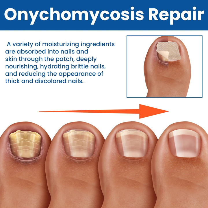 Fungal Revive Nail Treatment Patches | Targeted Repair for Nail Fungus, 60 Pieces 4